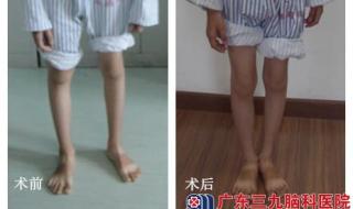 3岁男童手术后变脑瘫